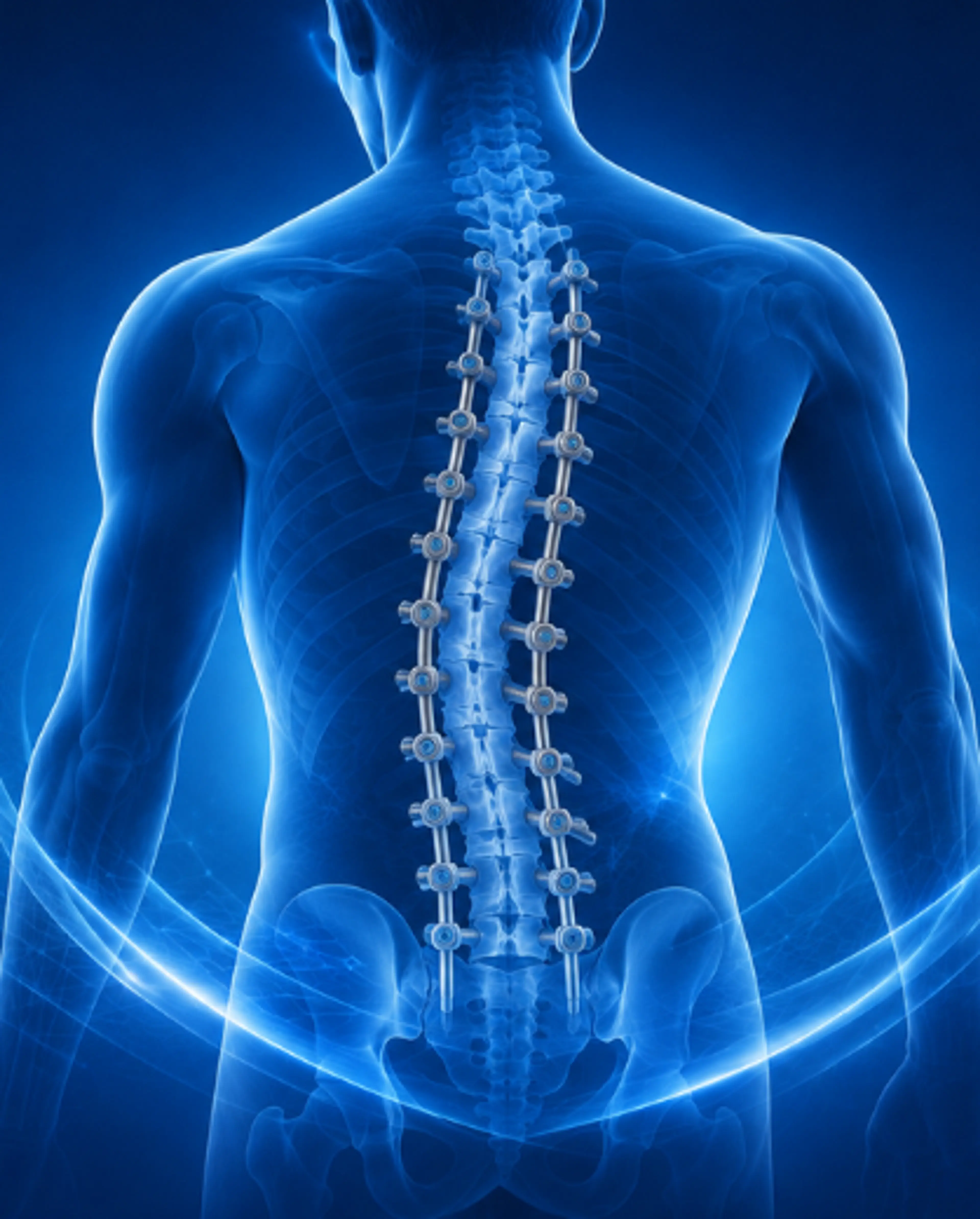 Scoliosis Correction Surgery