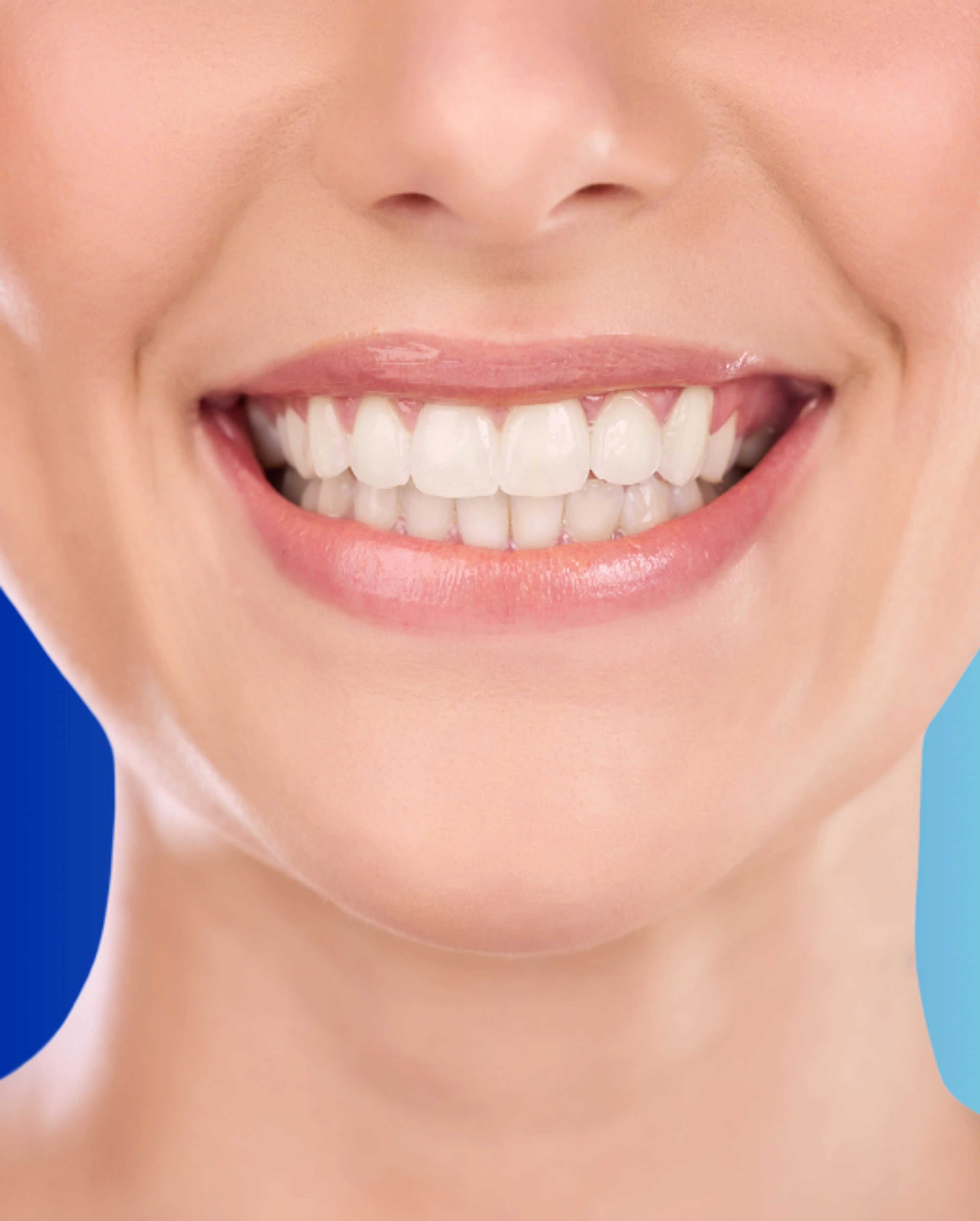 Blanchiment des dents