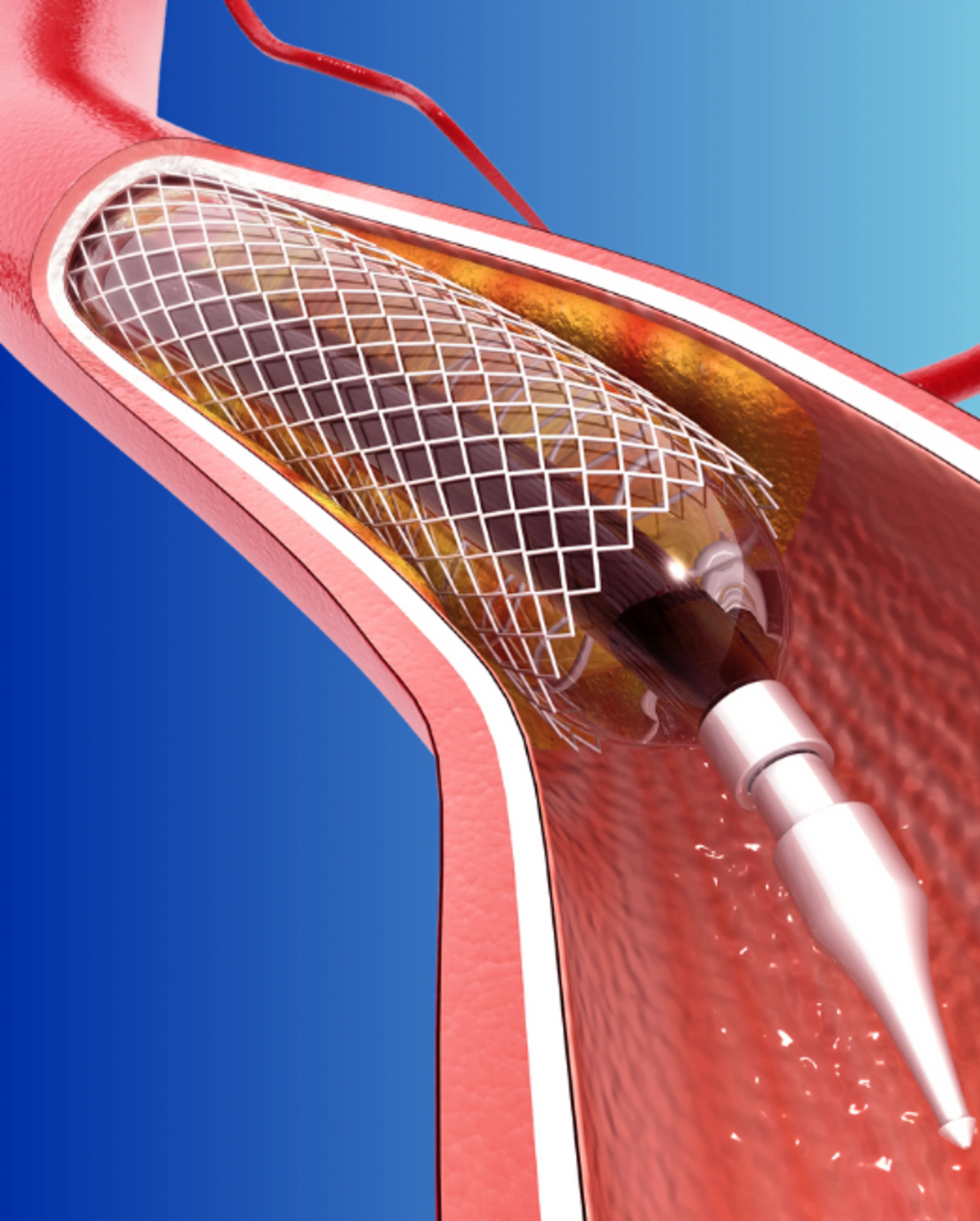 Angioplastia con balón